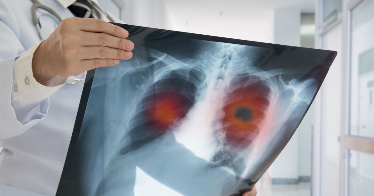 A doctor in a white coat holding a chest X-ray film showing highlighted areas in both lungs, indicating possible abnormalities or infections. The background is a bright, clinical hallway.
