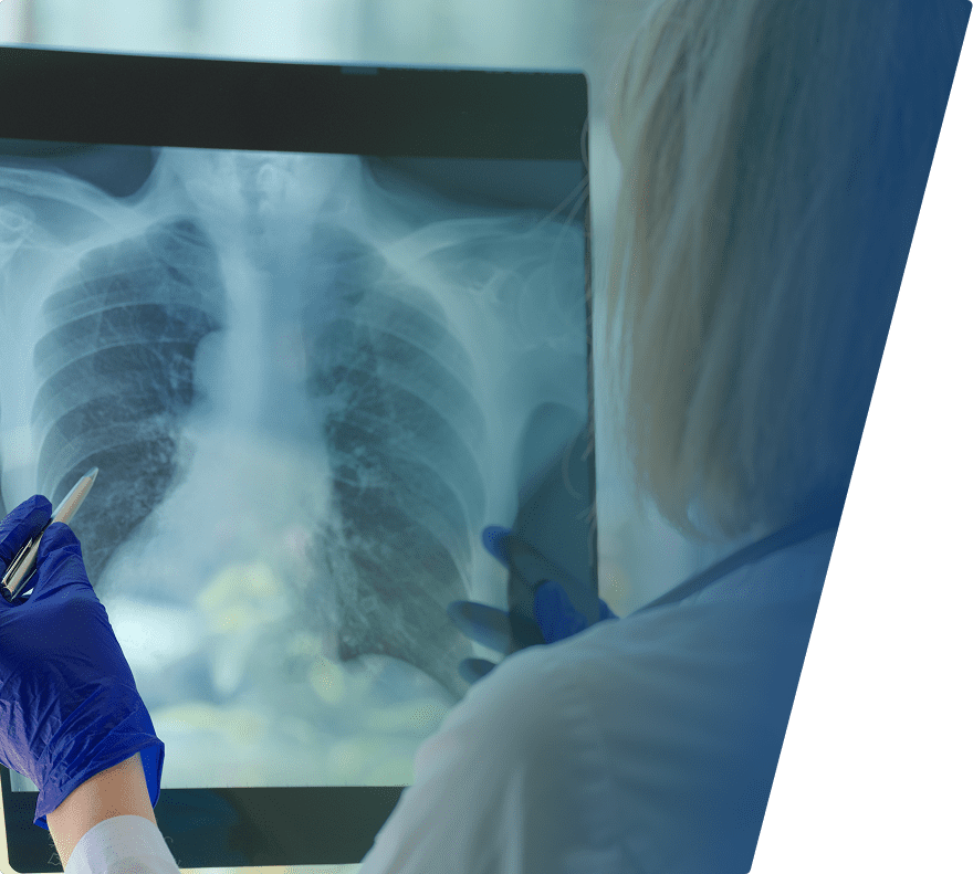 A medical professional wearing blue gloves is holding and examining a chest X-ray film showing the ribcage, lungs, and heart area. The person is pointing at the X-ray with a pen.