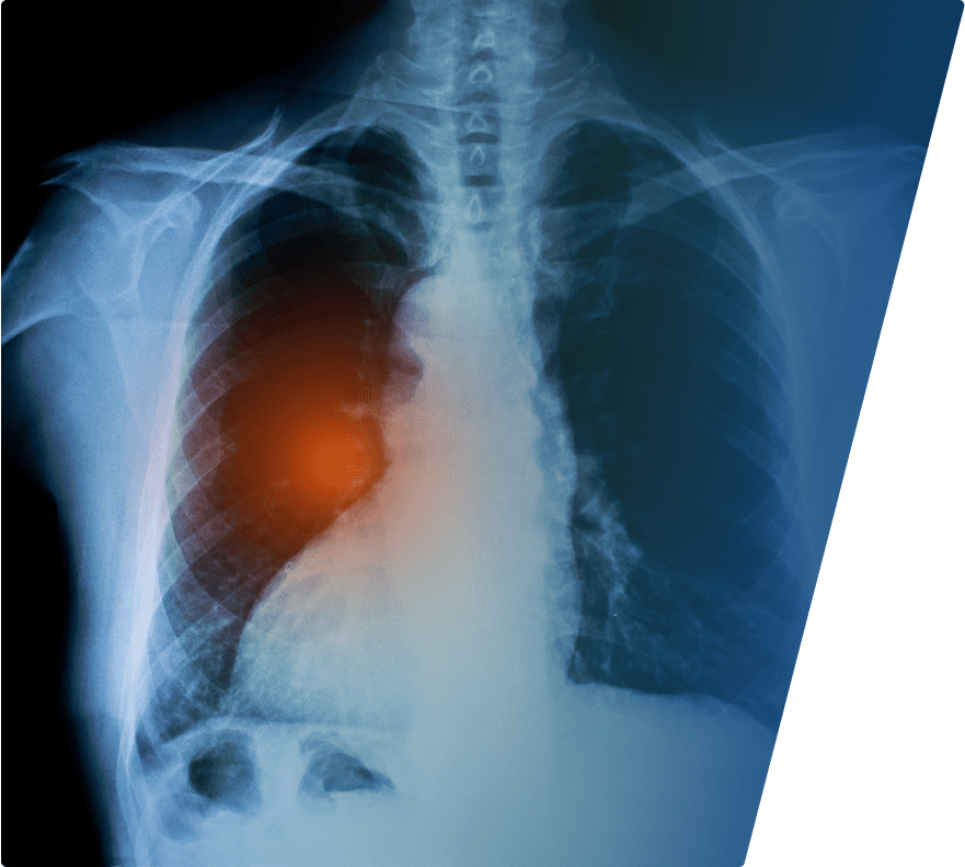 Chest X-ray showing the ribcage, spine, and lungs with a highlighted area of concern in the left lung, indicated by a red-orange glow.